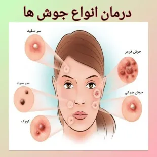 پک کبد چرب و ملتهب / پکیج جوش / پکیج تخصصی جوش و جای جوش