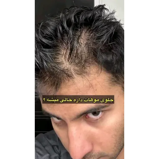 پکیج رویش موی لدورا