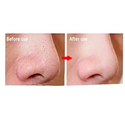 چسب بینی ویونسا اسپانیا