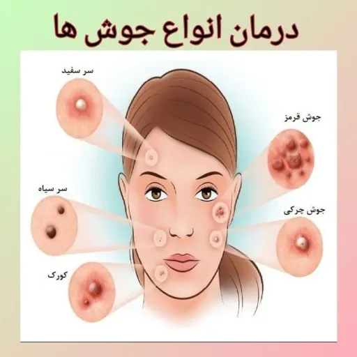 پک کبد چرب و ملتهب / پکیج جوش / پکیج تخصصی جوش و جای جوش